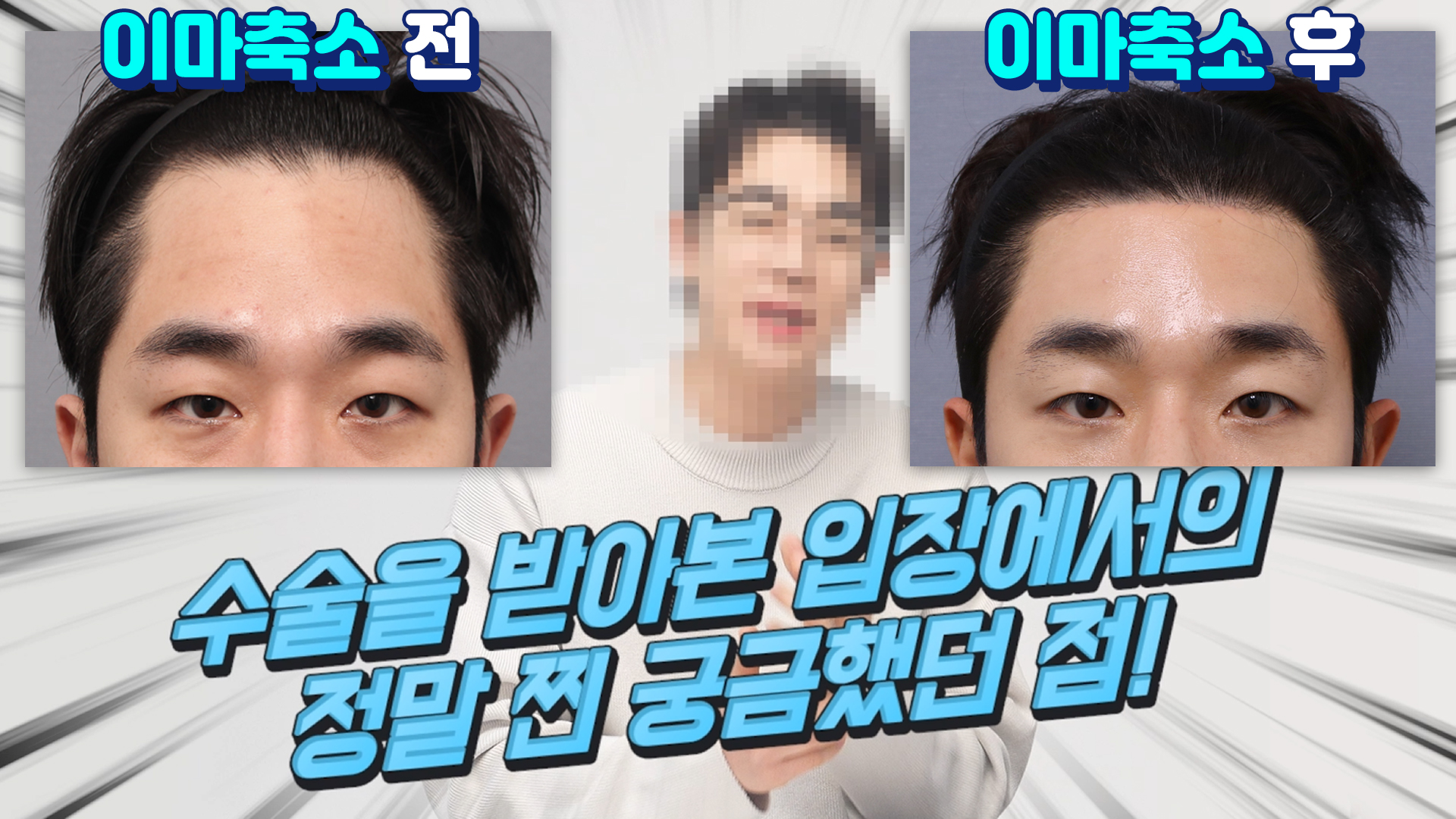 [테일러TV] 이마축소 수술하고 탈모, 흉터 걱정된다면 ???은 하면 안된다?